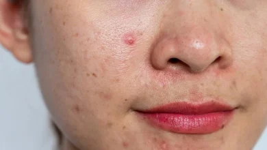 acne-prone skin