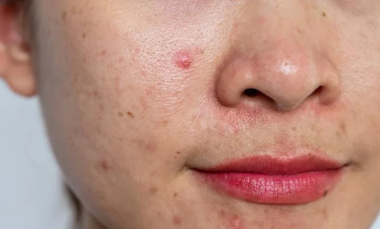 acne-prone skin